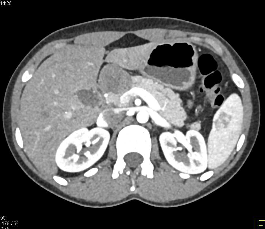 Solid and Papillary Epithelial Neoplasm (SPEN) Tumor Pancreas - CTisus CT Scan