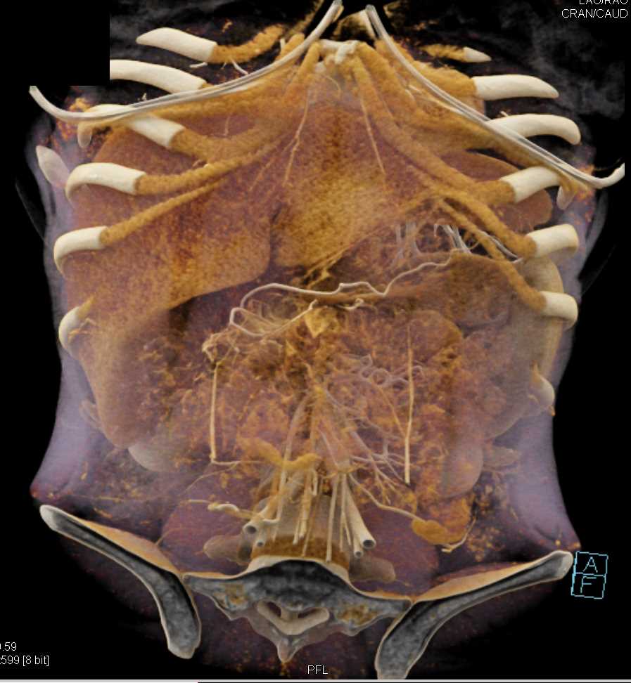 Solid and Papillary Epithelial Neoplasm (SPEN) Tumor Pancreas with Cinematic Rendering - CTisus CT Scan