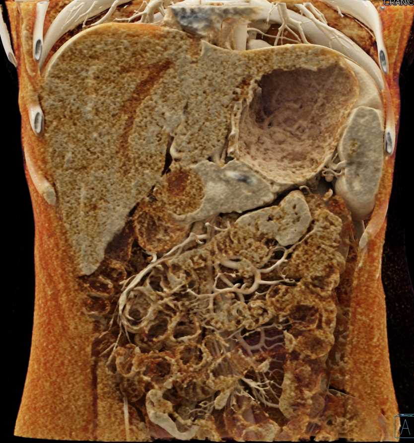 Solid and Papillary Epithelial Neoplasm (SPEN) Tumor Pancreas with Cinematic Rendering - CTisus CT Scan