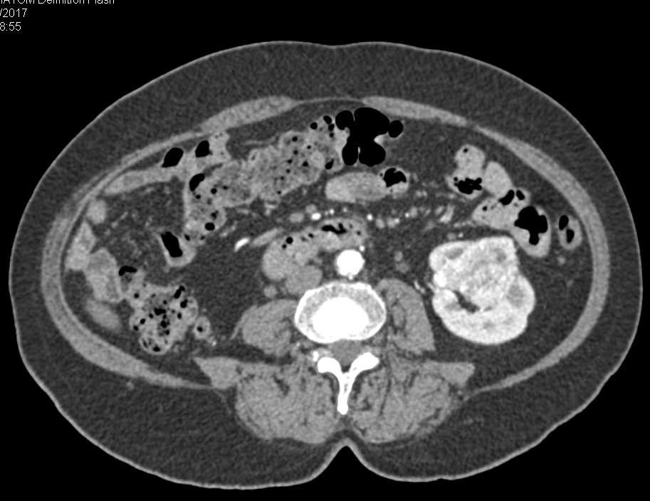 Metastatic Renal Cell Carcinoma to the Pancreas - CTisus CT Scan