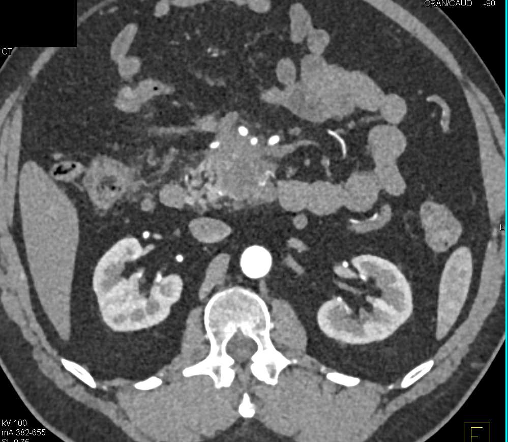 Carcinoma Head of Pancreas with Vascular Invasion - CTisus CT Scan