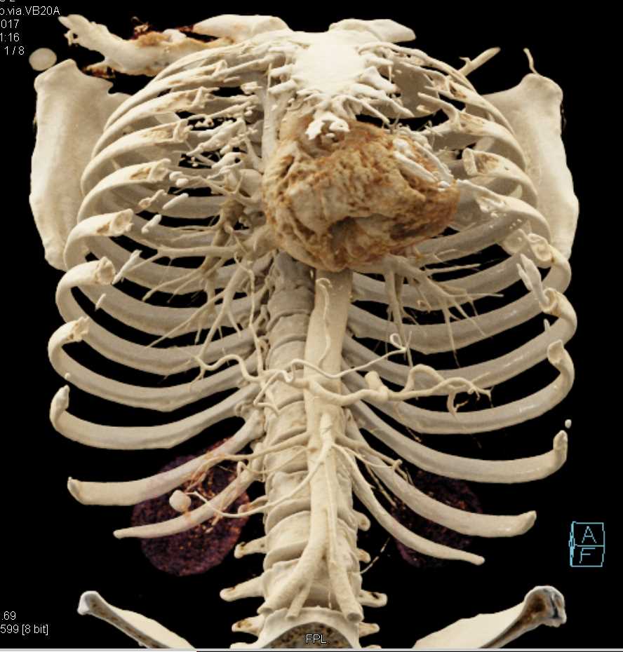 Mucinous Cystic Neoplasm Pancreas (MCN) - CTisus CT Scan