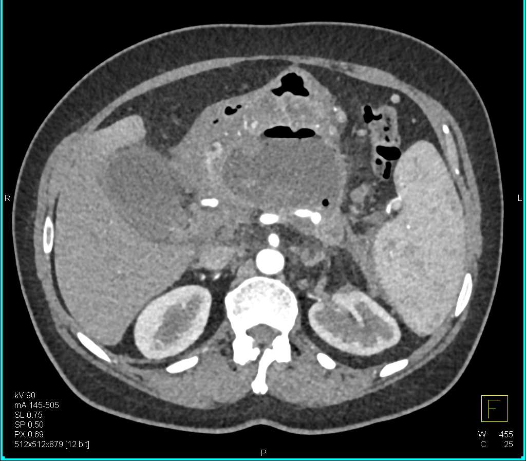 Mucinous Cystic Neoplasm Pancreas (MCN) with CTPV and Air Fluid Level Post Biopsy - CTisus CT Scan