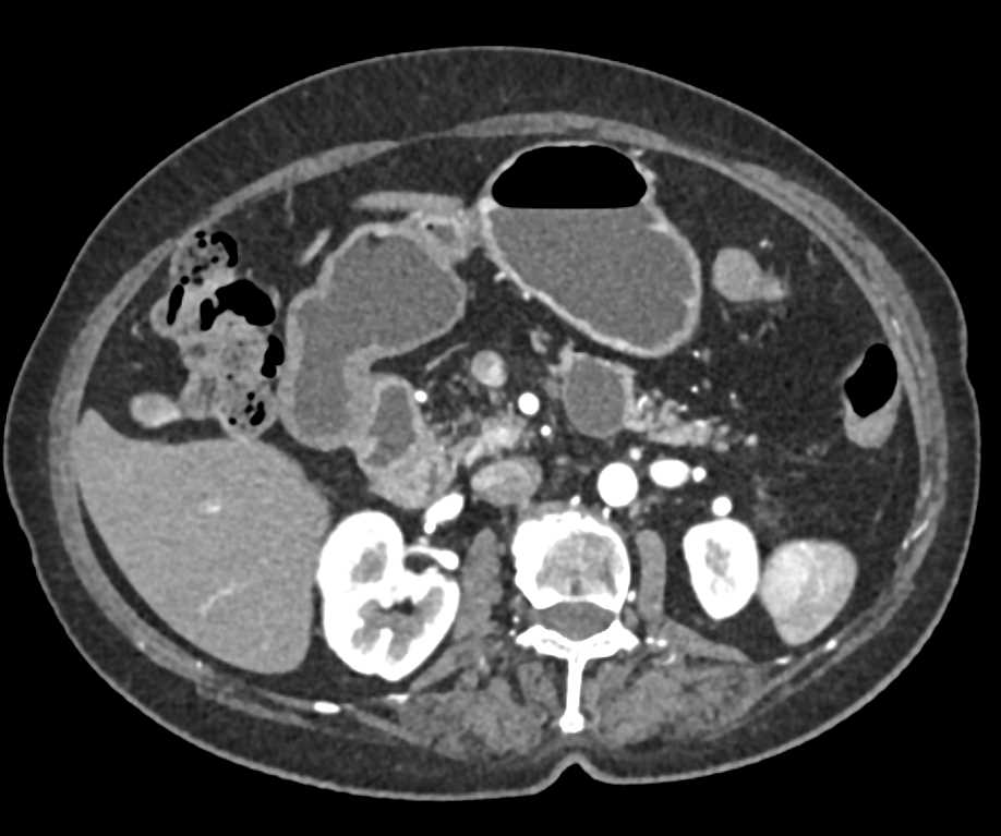 Intraductal Papillary Mucinous Neoplasm (IPMN) Body of the Pancreas - CTisus CT Scan