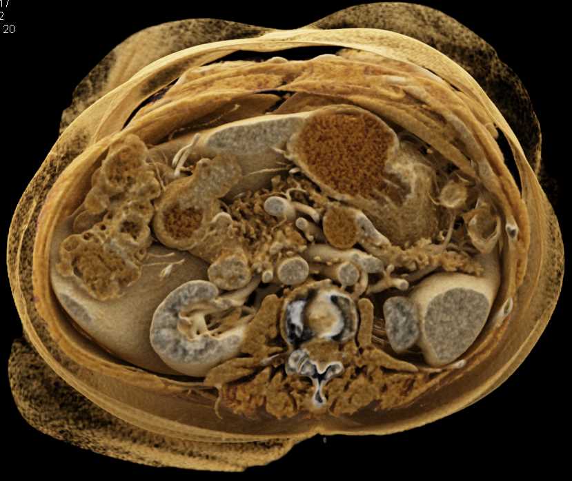 Intraductal Papillary Mucinous Neoplasm (IPMN) Pancreas - CTisus CT Scan