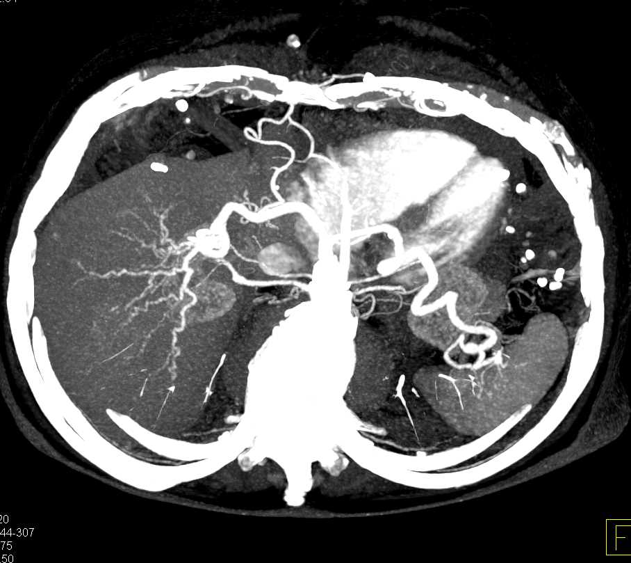 Pancreatic Cancer with Liver Metastases - CTisus CT Scan