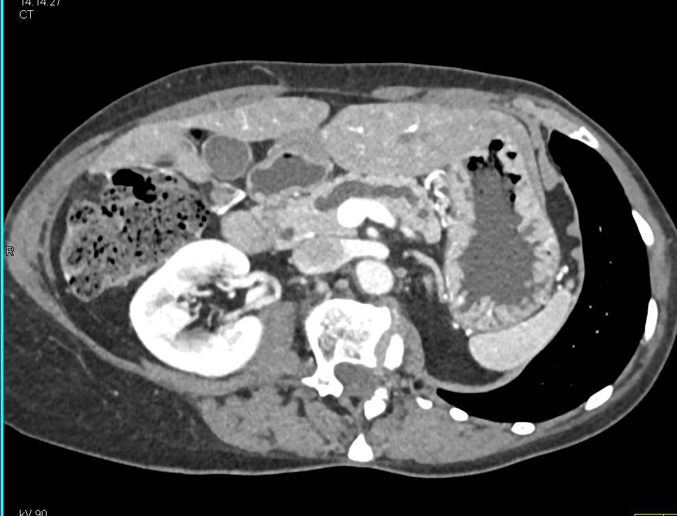 1cm Pancreatic Neuroendocrine Tumor (PNET) Obstructs the Pancreatic Duct - CTisus CT Scan