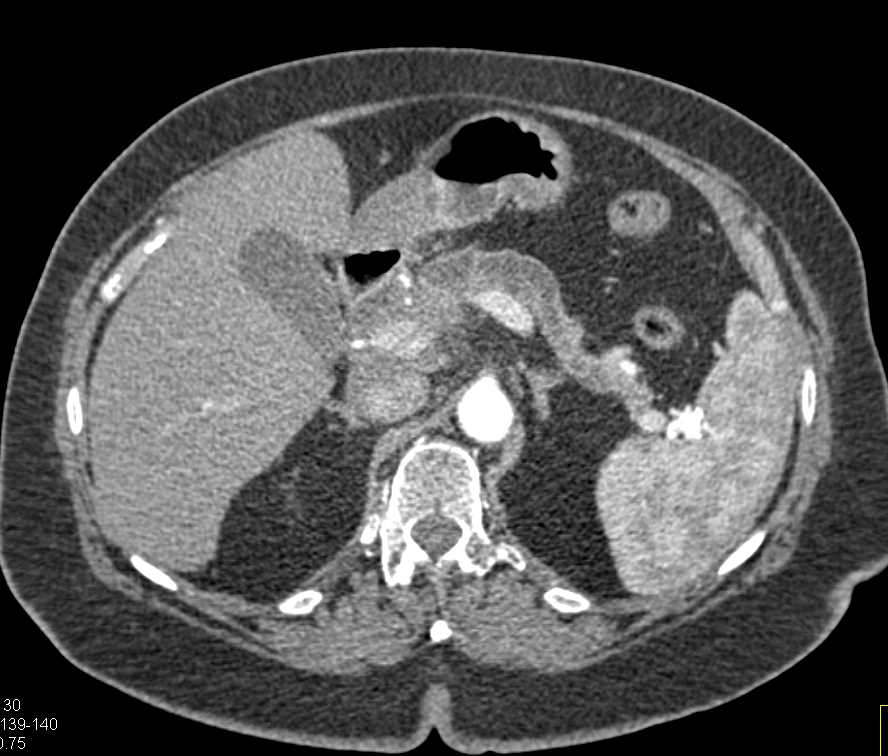 Carcinoma of the Pancreas Obstructs the Pancreatic Duct - CTisus CT Scan