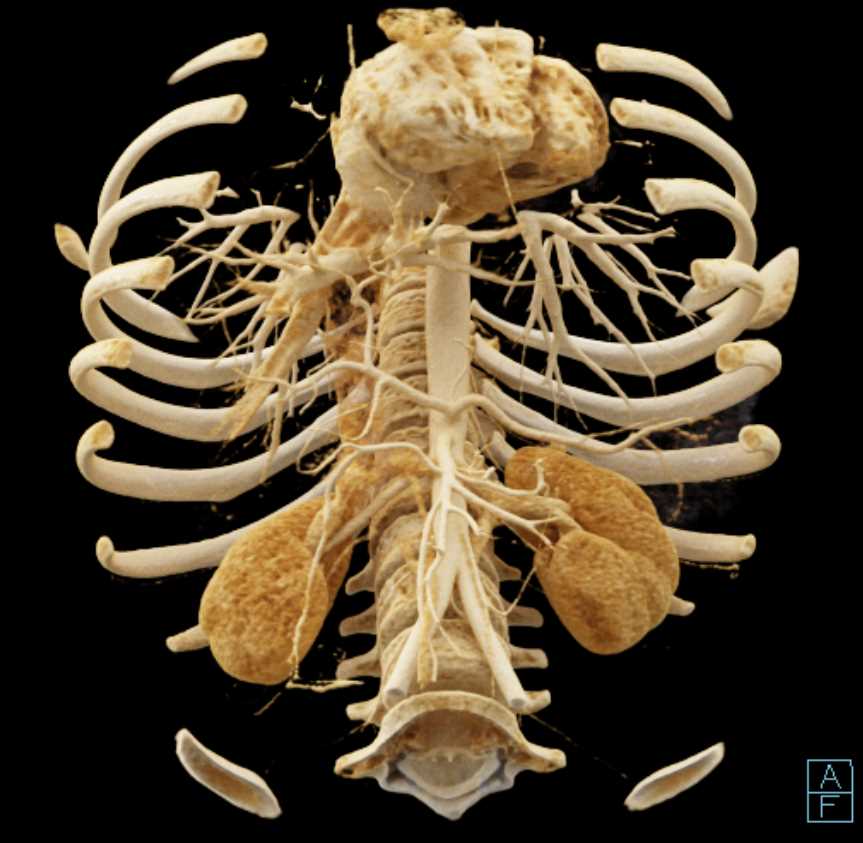 1cm Pancreatic Neuroendocrine Tumor (PNET) Tail of the Pancreas - CTisus CT Scan