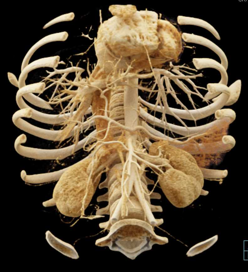 1cm Pancreatic Neuroendocrine Tumor (PNET) Tail of the Pancreas - CTisus CT Scan