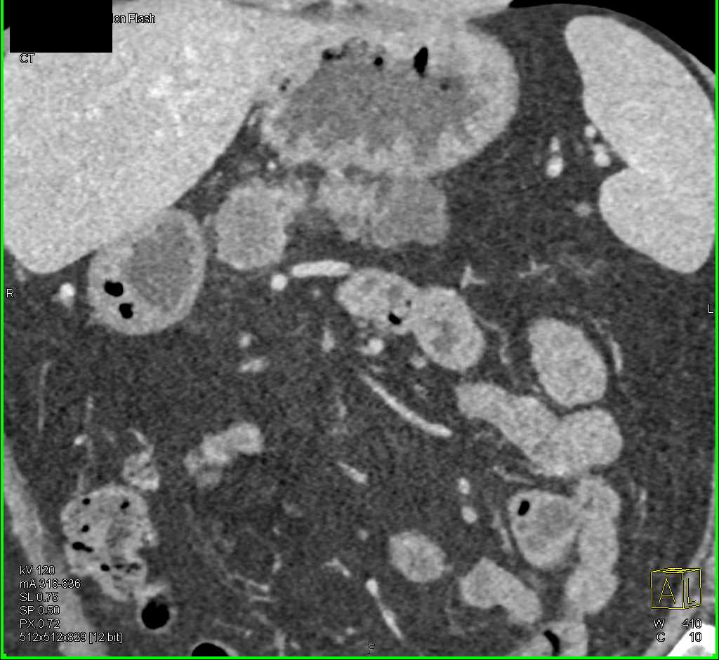 Multifocal Carcinoma of the Pancreas - CTisus CT Scan