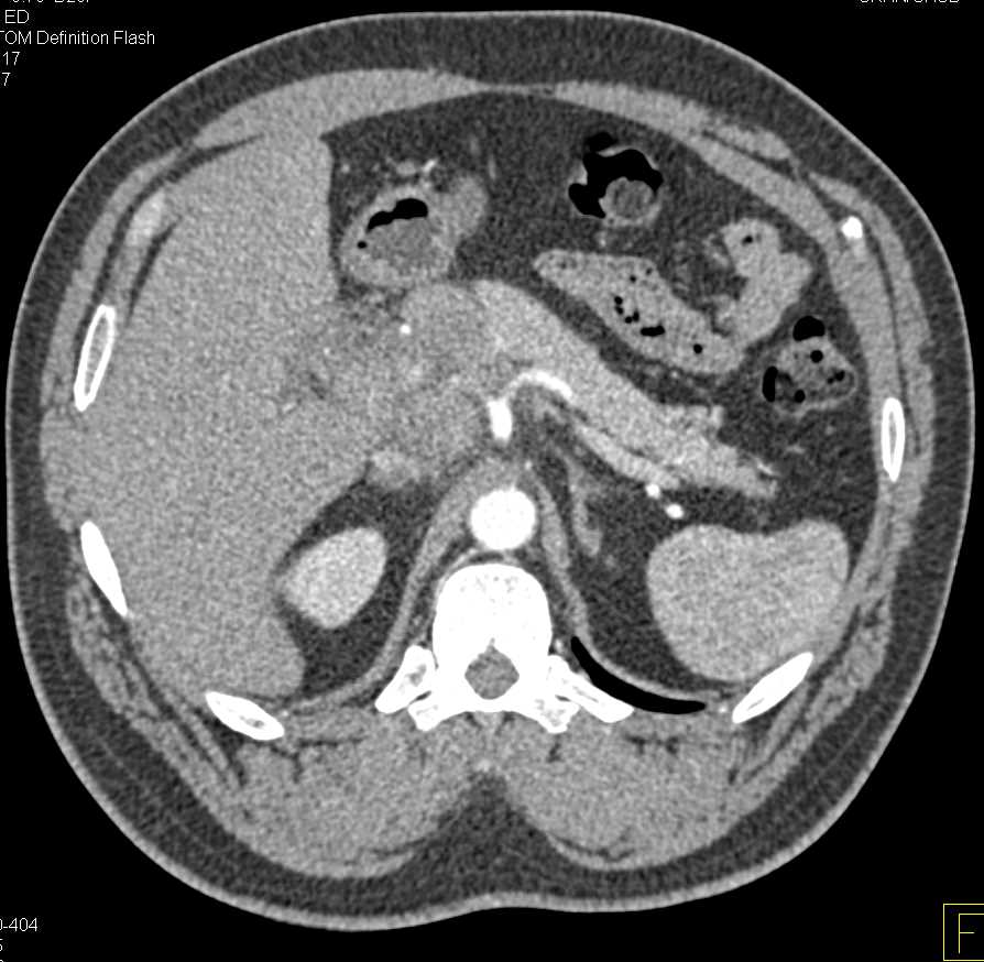 Carcinoma Head of Pancreas with Local Adenopathy - CTisus CT Scan