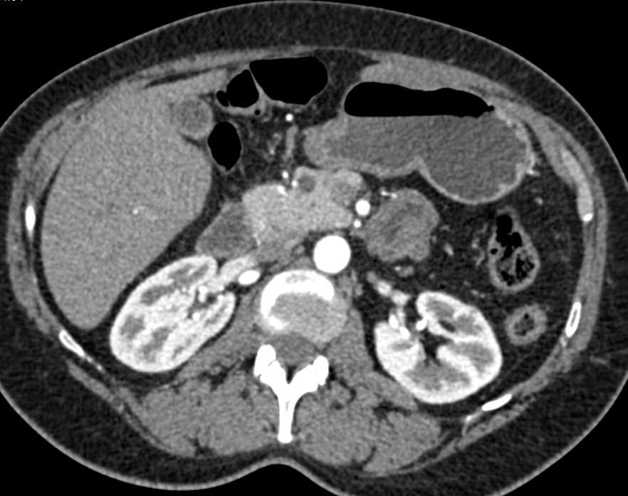 Intraductal Papillary Mucinous Neoplasm (IPMN) - CTisus CT Scan