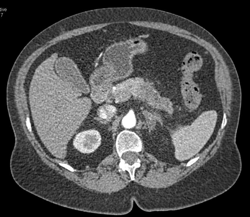 Carcinoma Body of the Pancreas - CTisus CT Scan