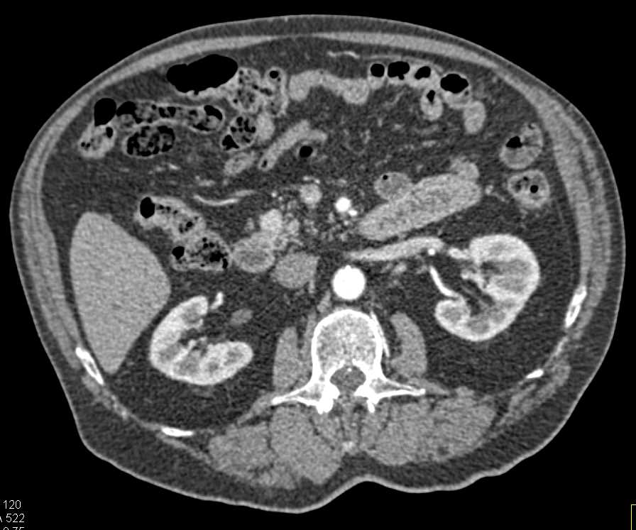 1cm Pancreatic Neuroendocrine Tumor (PNET) in the Head of the Pancreas - CTisus CT Scan