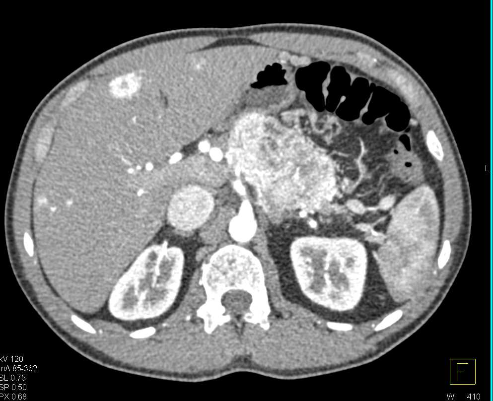 Neuroendocrine Tumor in the Body of the Pancreas with Liver Metastases - CTisus CT Scan