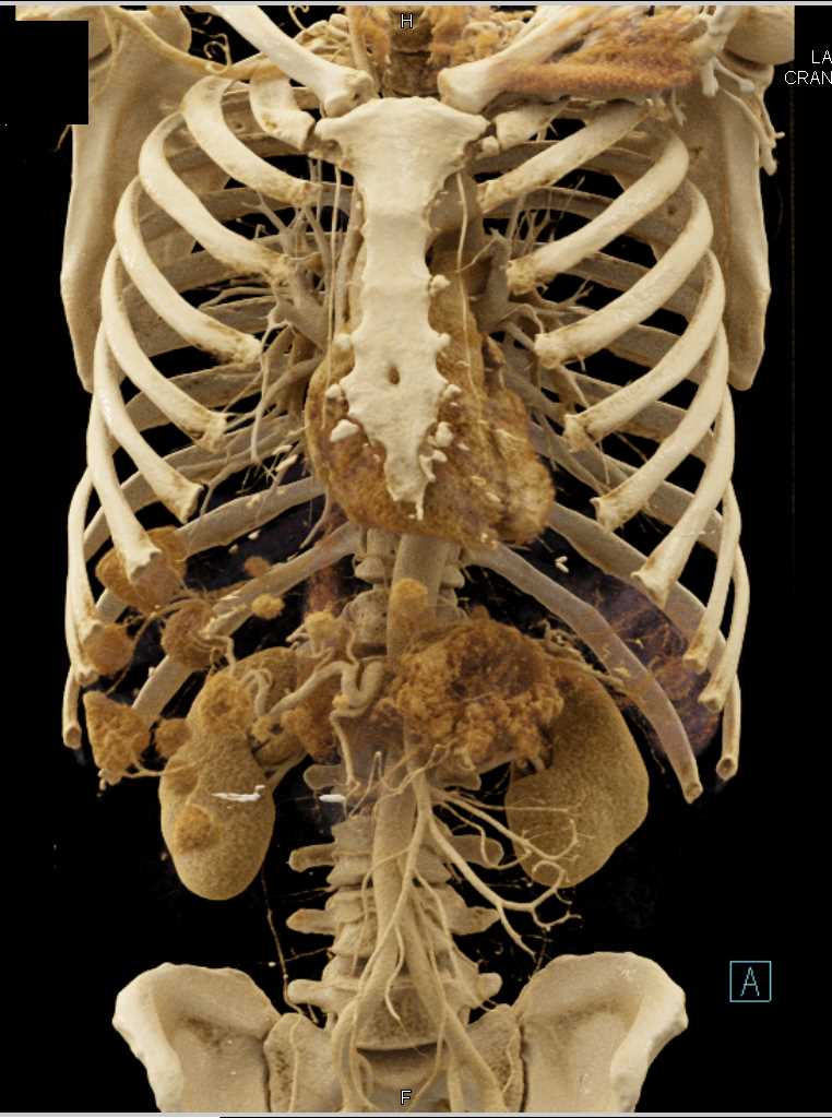 Pancreatic Neuroendocrine Tumor (PNET) with Vascular Liver Metastases with Cinematic Rendering - CTisus CT Scan