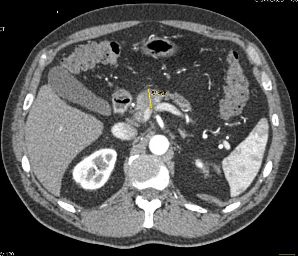 Carcinoma Head of the Pancreas - CTisus CT Scan