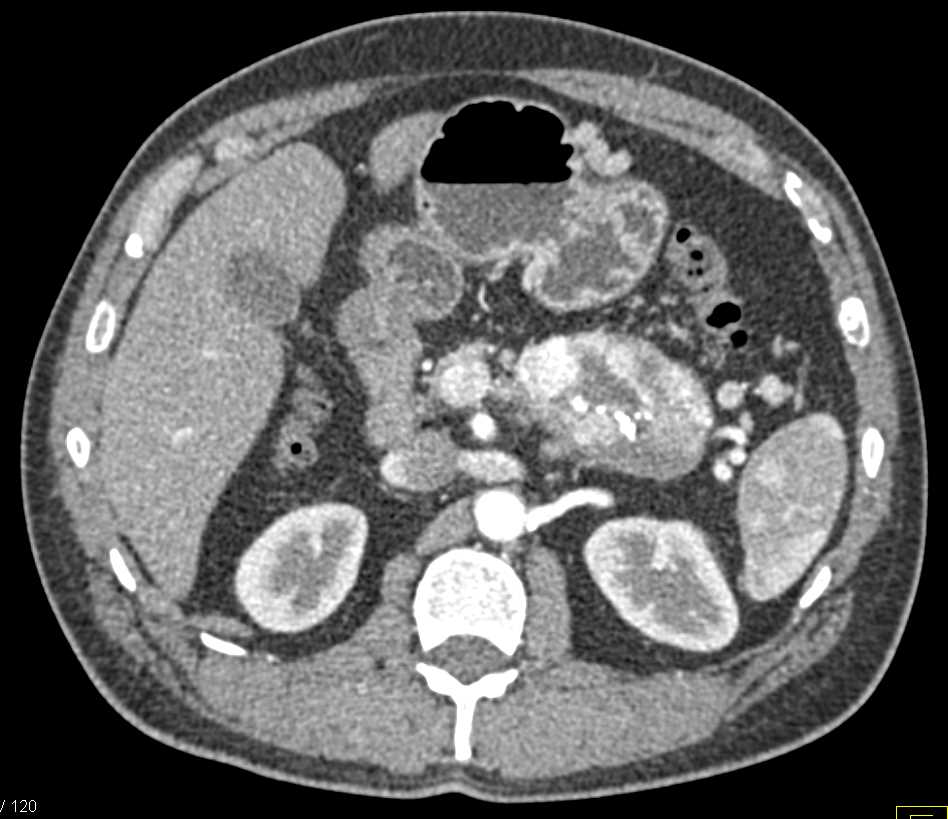 Neuroendocrine Tumor of the Pancreas with Calcifications - CTisus CT Scan