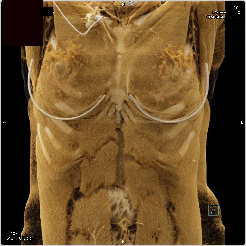 Carcinoma Head of the Pancreas - CTisus CT Scan