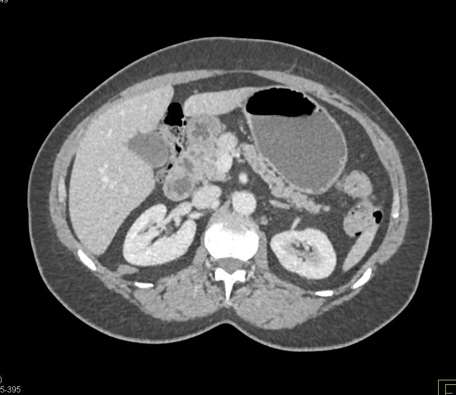 Carcinoma Head of the Pancreas - CTisus CT Scan