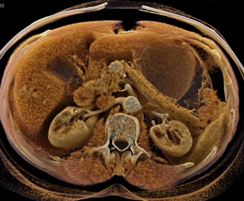 Pancreatic Neuroendocrine Tumor (PNET) Pancreas - CTisus CT Scan