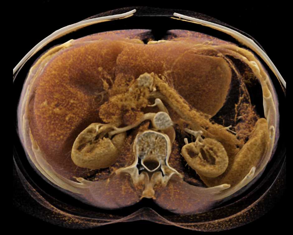 Pancreatic Neuroendocrine Tumor (PNET) Pancreas - CTisus CT Scan