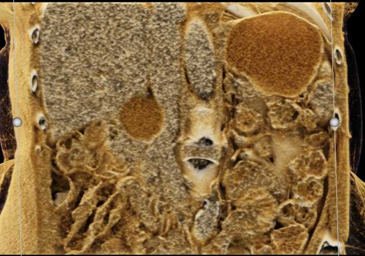 Intraductal Papillary Mucinous Neoplasm (IPMN) Pancreas - CTisus CT Scan