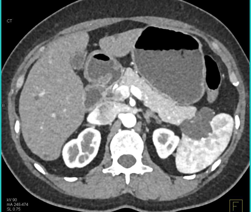 Lymphoepithelial Cyst Tail of the Pancreas - CTisus CT Scan