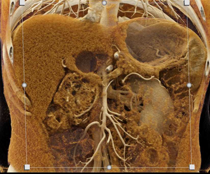 Serous Cystadenoma Pancreas with Cinematic Rendering - CTisus CT Scan