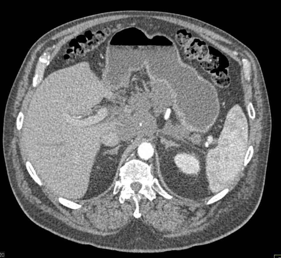 Lymphoma Simulating Pancreatic Cancer - CTisus CT Scan