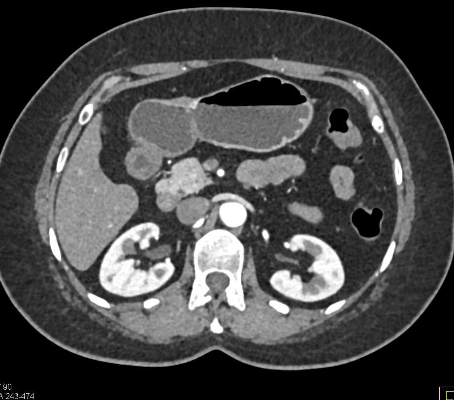 1cm Intraductal Papillary Mucinous Neoplasm (IPMN) Head of the Pancreas - CTisus CT Scan