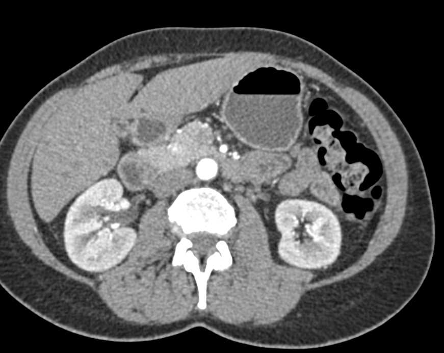 8mm Pancreatic Neuroendocrine Tumor (PNET) in the Head of the Pancreas - CTisus CT Scan