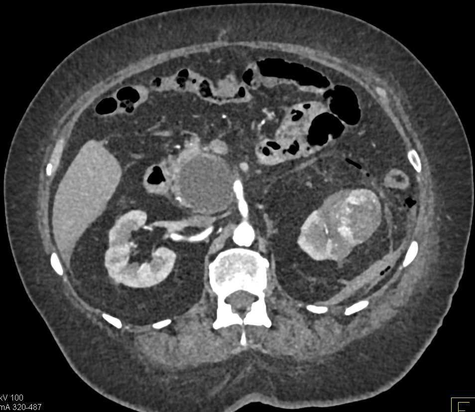 Left Renal Cell Carcinoma and Pancreatic Pseudocysts - CTisus CT Scan