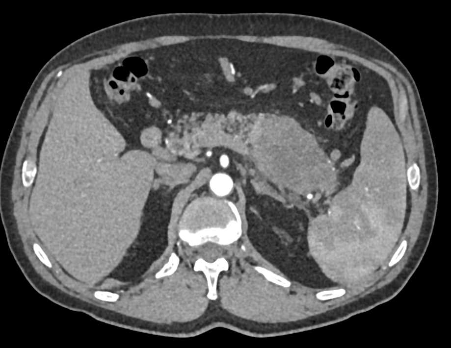 Adenocarcinoma Tail of Pancreas - CTisus CT Scan