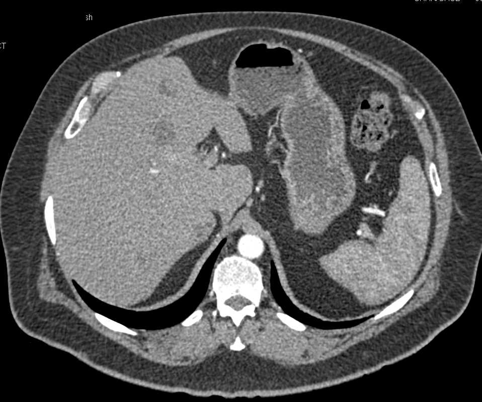 Neuroendocrine Tumor Pancreas - CTisus CT Scan