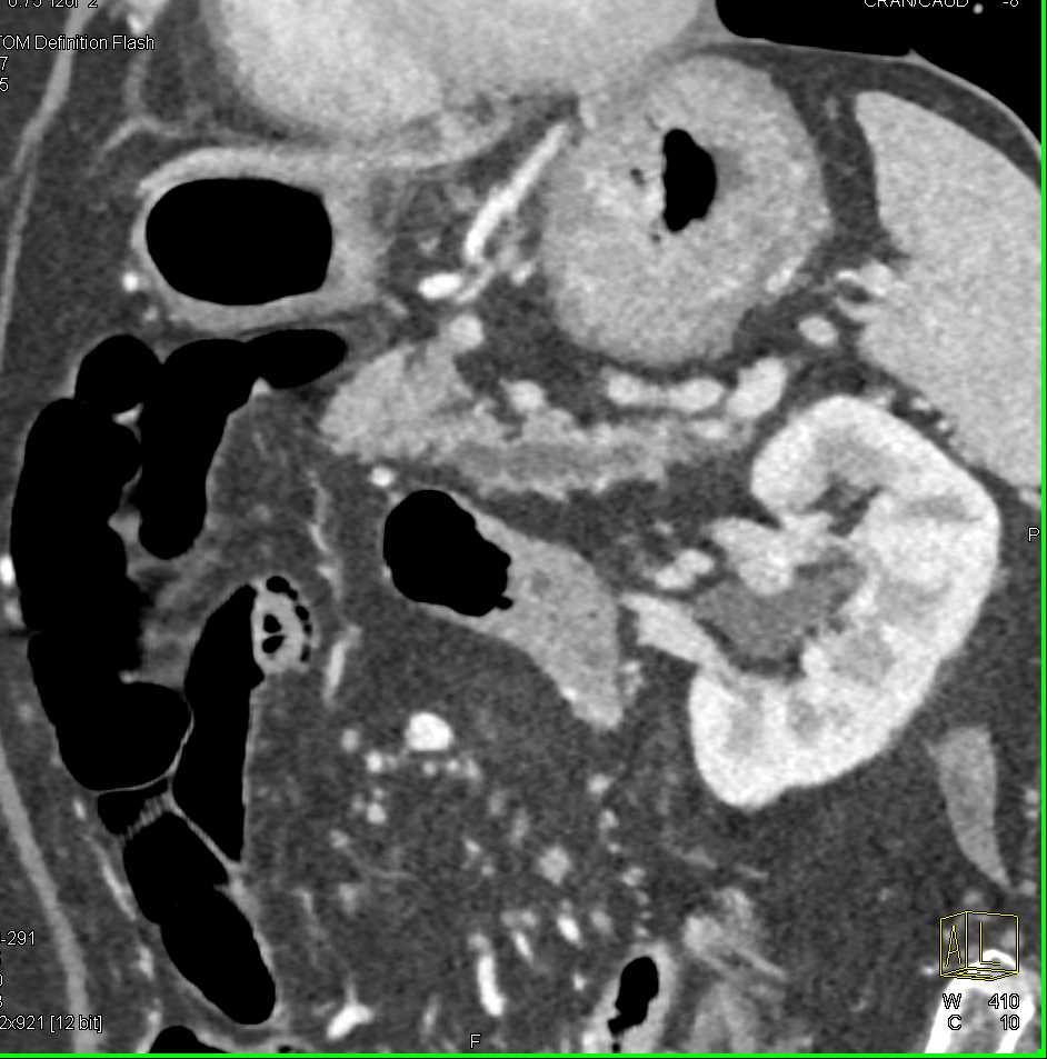 Pancreas Cancer with Dilated Pancreatic Duct - CTisus CT Scan
