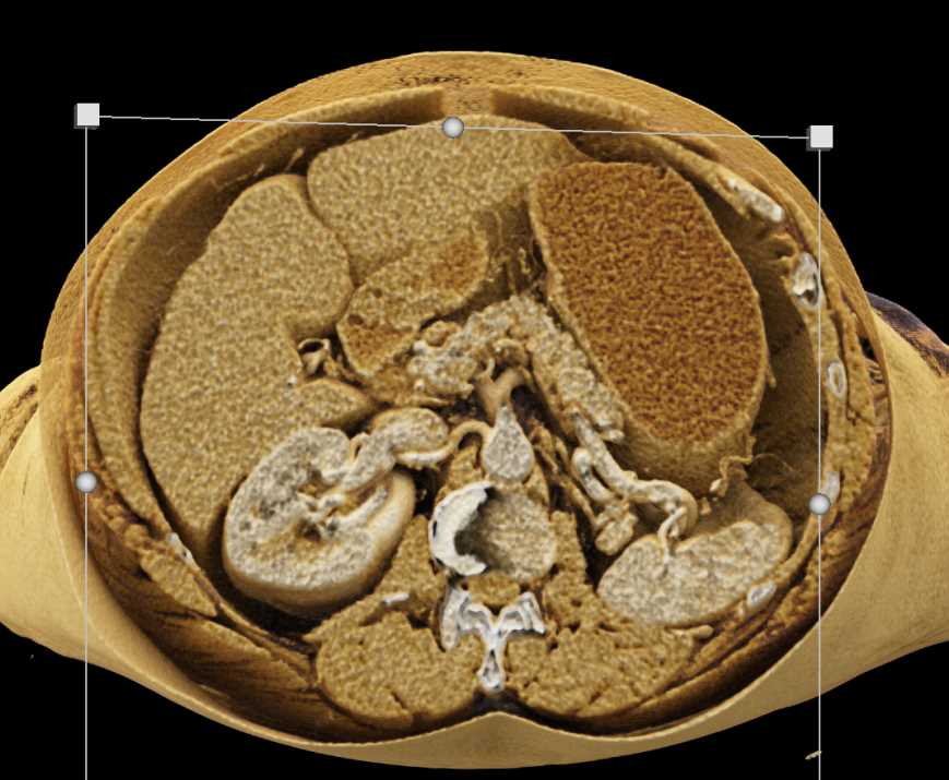 1cm Pancreatic Neuroendocrine Tumor (PNET) Head of Pancreas - CTisus CT Scan