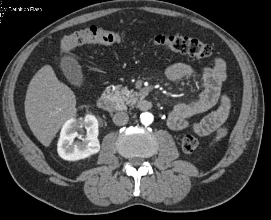 Neuroendocrine Tumor Head of Pancreas - CTisus CT Scan