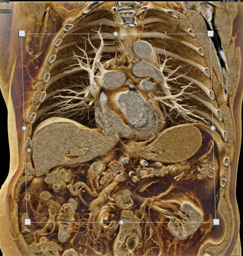 Neuroendocrine Tumor Head of Pancreas with Cinematic Rendering - CTisus CT Scan