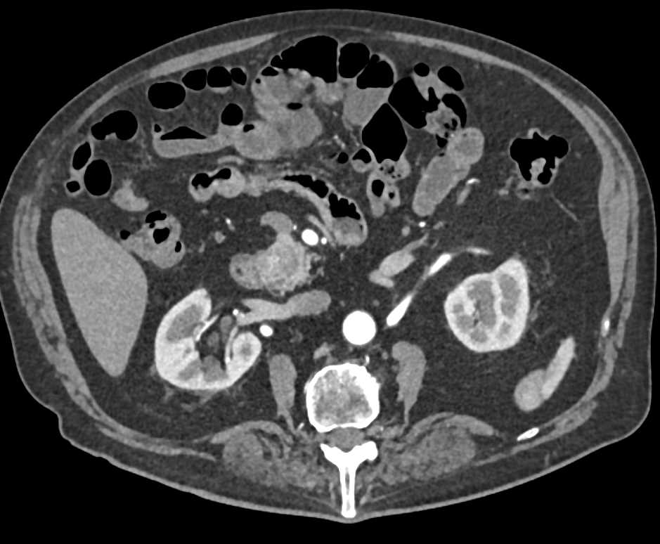 Neuroendocrine Tumor Head of Pancreas - CTisus CT Scan