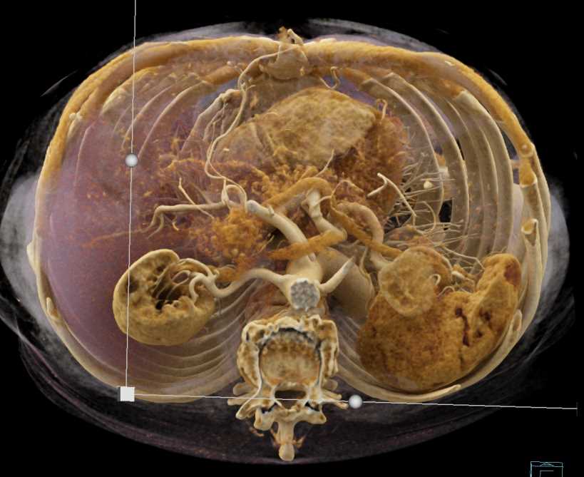 Pancreas Adenocarcinoma with Cinematic Rendering - CTisus CT Scan