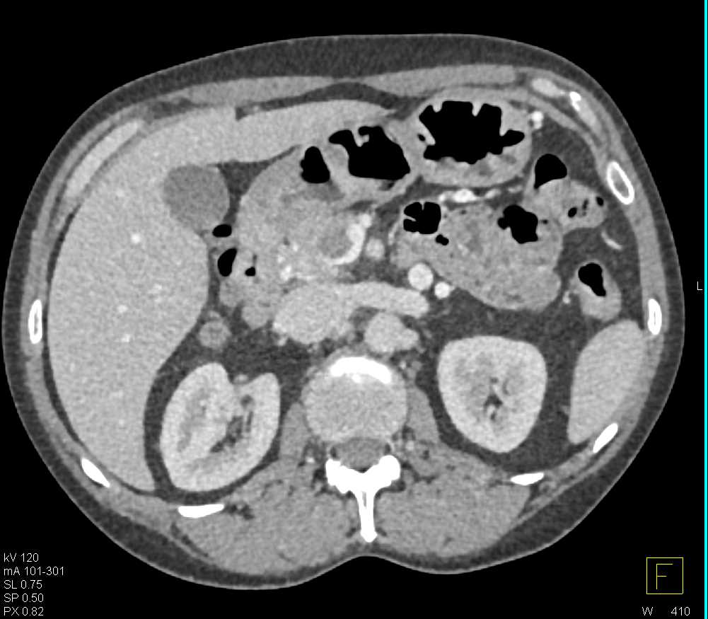 Pancreatc Adenocarcinoma Involves the Portal Vein - CTisus CT Scan