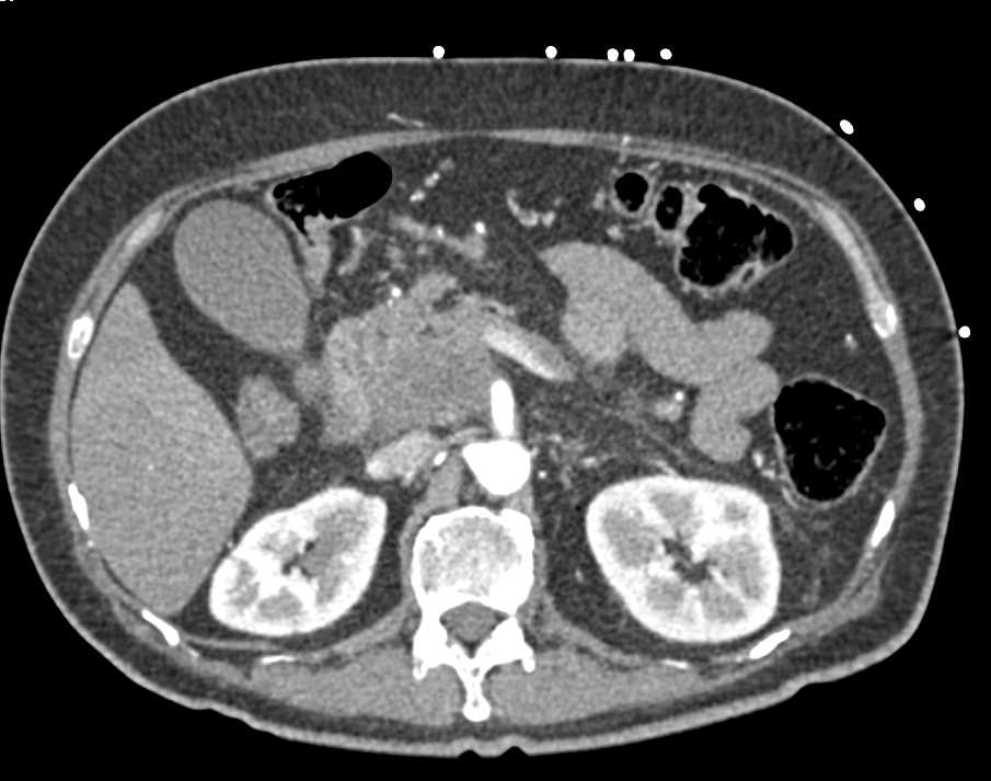 Carcinoma Head of Pancreas with Vascular Involvement and Liver Metastases - CTisus CT Scan