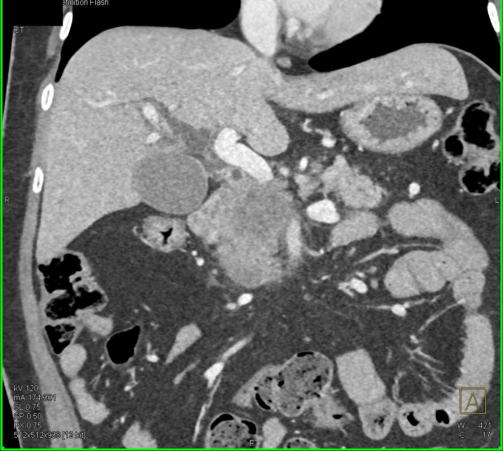 Carcinoma Head of Pancreas with Vascular Involvement and Liver Metastases - CTisus CT Scan