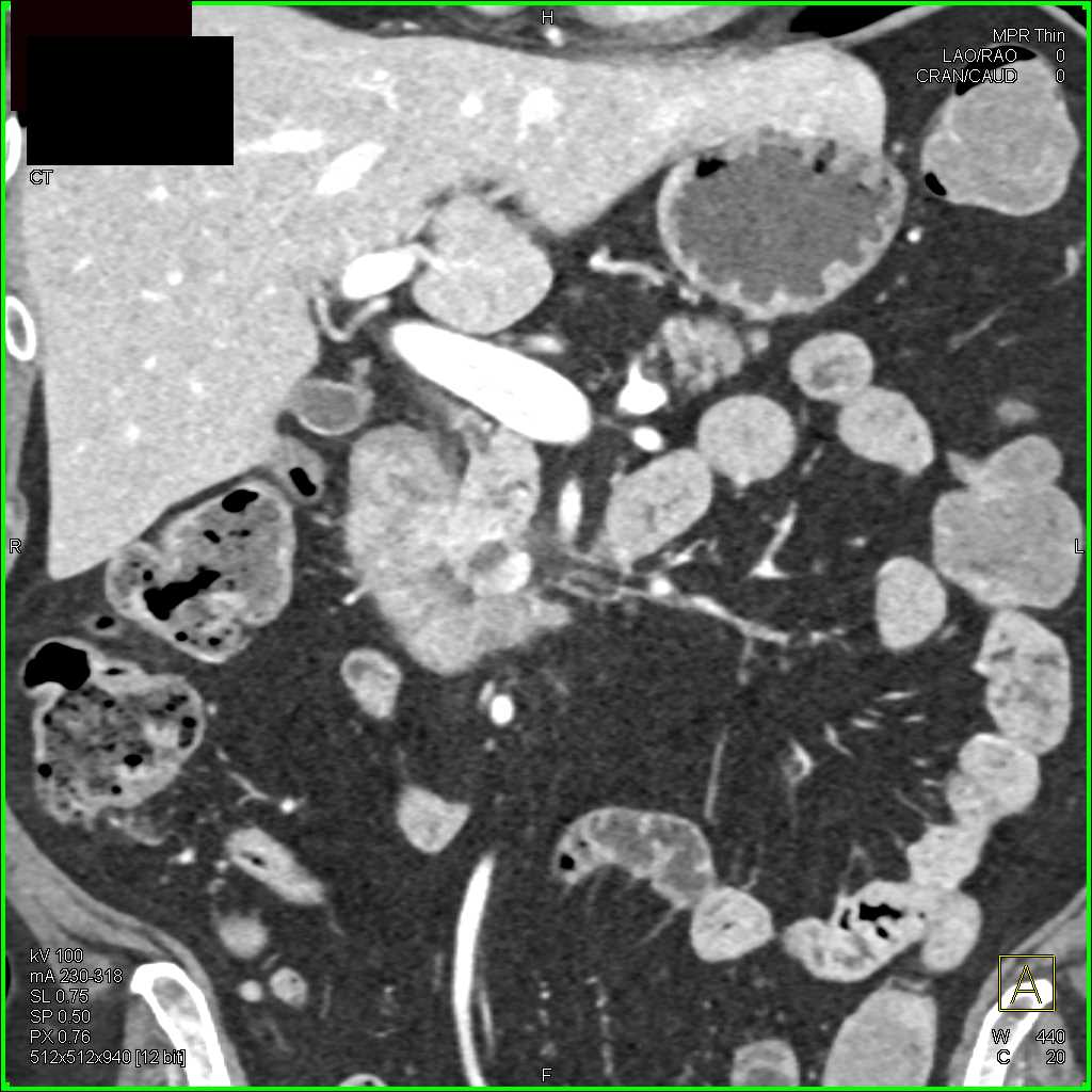 Pancreatic Neuroendocrine Tumor (PNET) Head of Pancreas - CTisus CT Scan