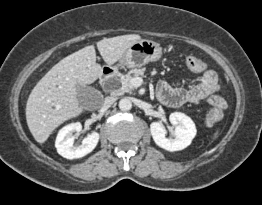 Carcinoma Head of Pancreas with Double Duct Sign - CTisus CT Scan