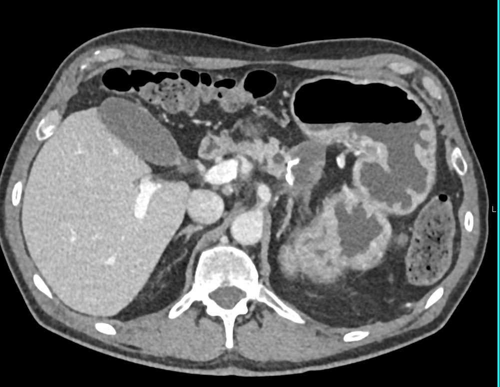 Recurrent Pancreatic Cancer - CTisus CT Scan