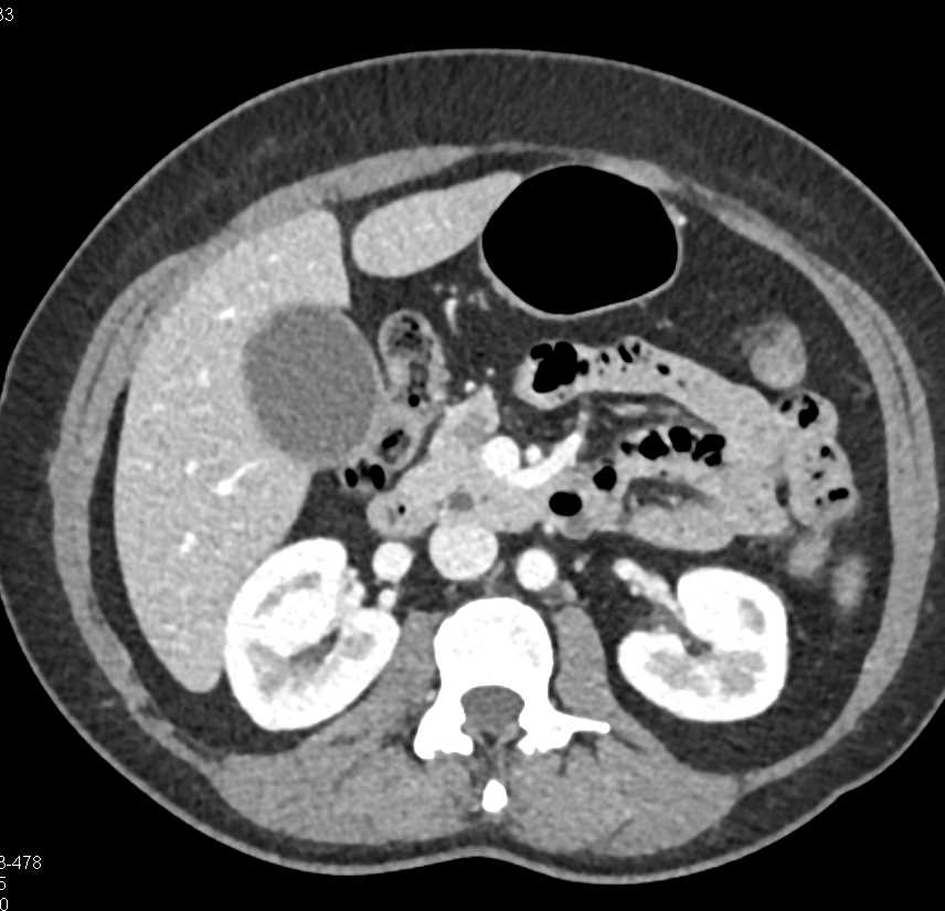 Subtle Pancreatic Adenocarcinoma - CTisus CT Scan