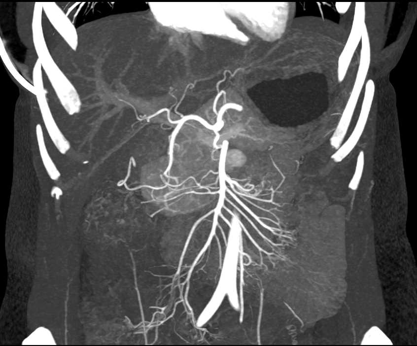 Neuroendocrine Tumor Head of Pancreas - CTisus CT Scan